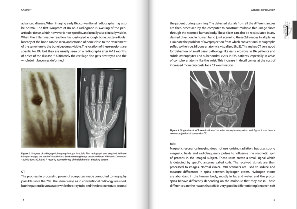 Arthritis PhD Dissertation Samples - Writing a PhD Thesis on Arthritis Stats arthritis dissertation